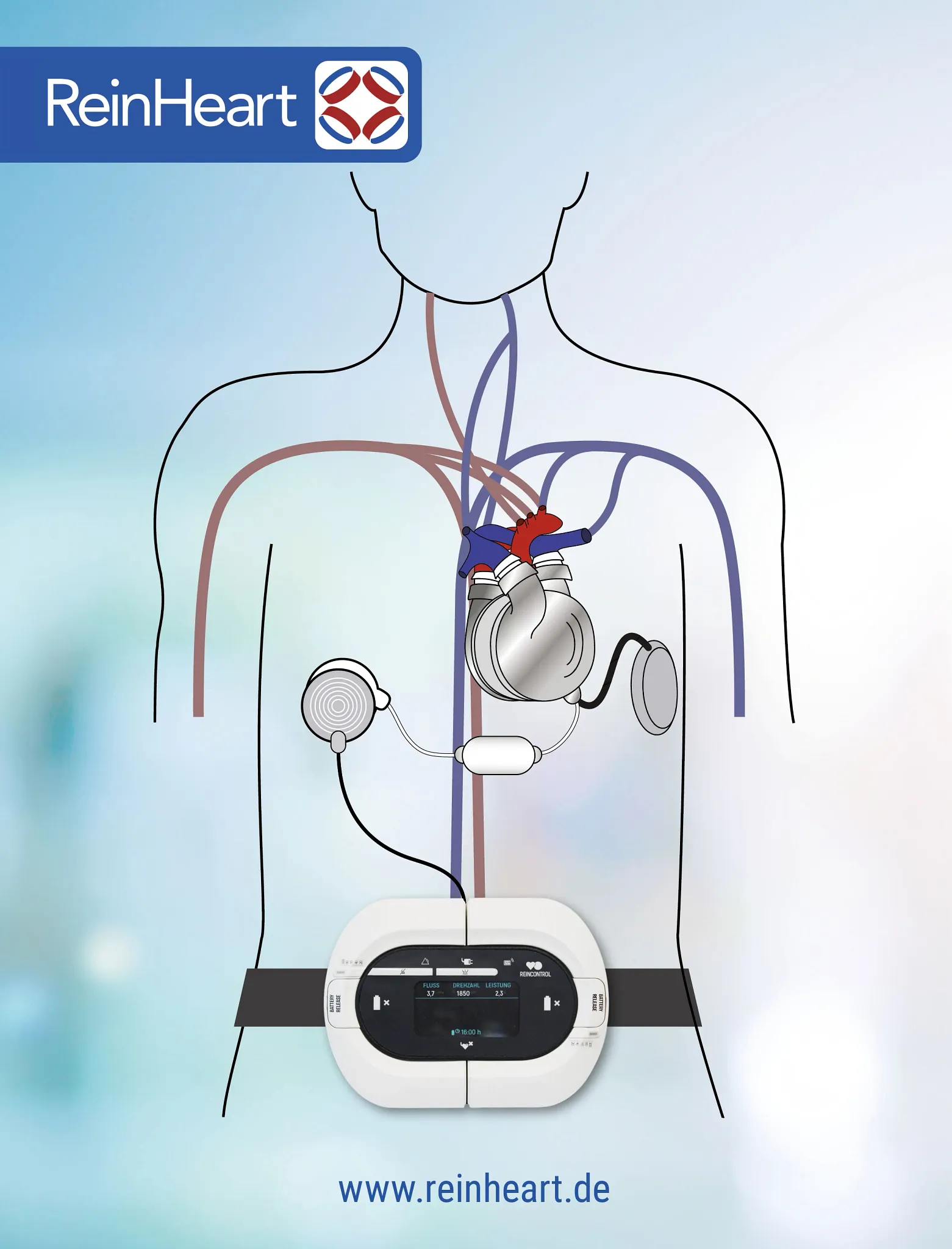 Umělé srdce ReinHeart